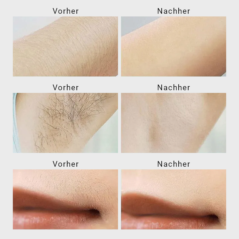 Qral IPL Expert Pro 8 - Haarfrei in 8 Wochen